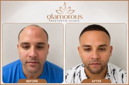 before and after of Dhi Hair Transplant in Dubai
