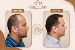 before and after result of Hair transplant in Dubai by Dr Hamid Ali Esmaeilpour at Glamorous clinic Dubai 