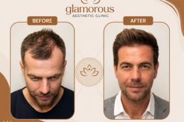 before and after results in Glamorous clinic Dubai & Sharjah 