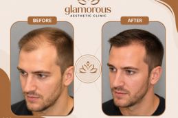 Hair Transplant result in Glamorous clinic Dubai
