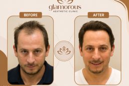 before and after results in Glamorous clinic Dubai and Abudhabi