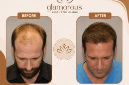 before and after results of Hair Transplant in Glamorous clinic Dubai