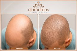 before and after results of Dhi Hair Transplant in Dubai