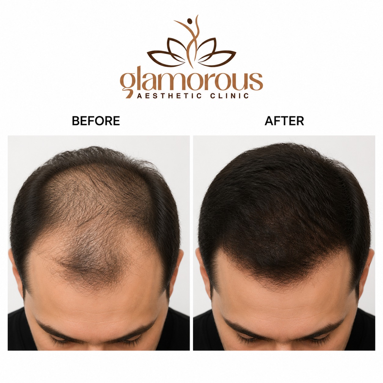 Before and after Hair Transplant results at Glam Clinic Dubai