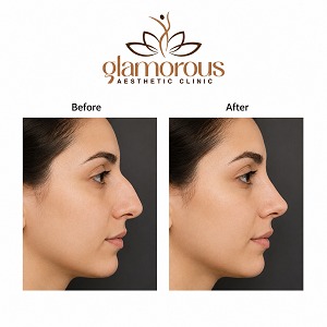 Before and after Rhinoplasty results at Glam Clinic Dubai