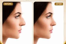 rhinoplasty before and After Dubai Abu Dhabi UAE