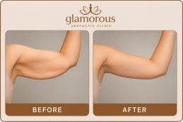 Arm Lift Surgery in Dubai & Abu Dhabi Sharjah