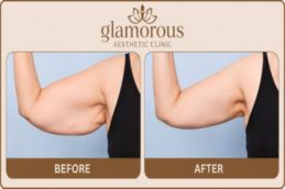 Arm Lift Surgery in Dubai & Abu Dhabi