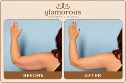 Arm Lift Surgery in Dubai