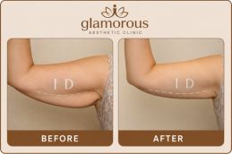 Arm Lift SurgeryBefore and After in Dubai