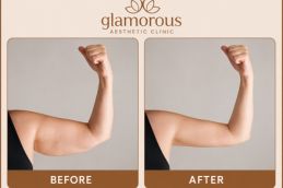 Arm Lift SurgeryBefore and After in Dubai at glam clinic