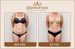 Before and After Rsults of Tummy Tuck in Dubai