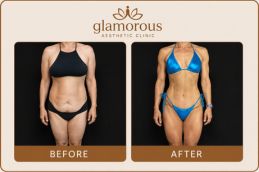 Before and After Rsults of Tummy Tuck inAbu Dhabi