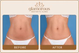 Before and After Rsults of Tummy Tuck