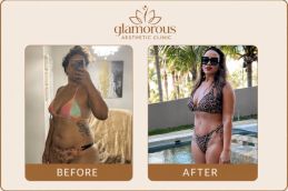 Before and After Tummy Tuck in Dubai & Abu Dhabi