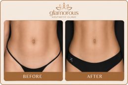Before and After Tummy Tuck in Dubai