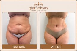 Before and After Tummy Tuck