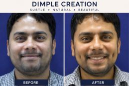 Before and after results in Dubai