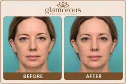 Brow lift Surgery Before and After result in Dubai at glam clinic