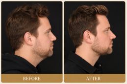 Buccal fat removal before and After results dubai (1)