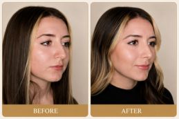 Buccal fat removal before and After results dubai