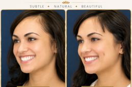 Dimple creation Before and after results in Dubai Abu Dhabi