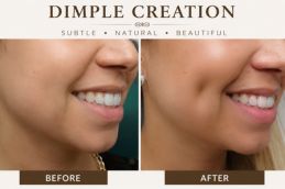 Dimple creation result in Dubai