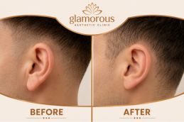 Ear Reshaping Before and After in Dubai , Abu Dhabi