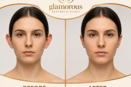 Ear Reshaping Before and After in Dubai