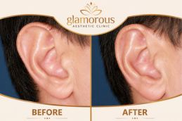 Ear Reshaping Results in Dubai , Abu Dhabi
