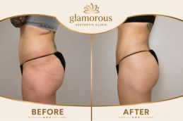 Fat Removal Before and After Dubai & Abu Dhabi