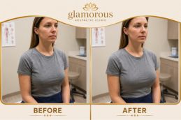 Fat Removal Before and After Dubai UAE