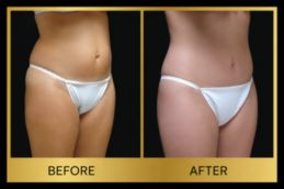 Fat Removal Before and After Results in Dubai UAE