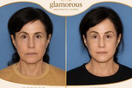 Fat Removal Results Dubai & Abu Dhabi