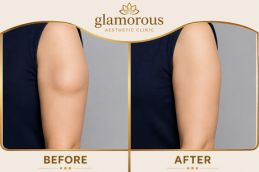 Lipoma Results Dubai & Abu Dhab Glam