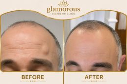Lipoma treatment Results Dubai & Abu Dhab Glami