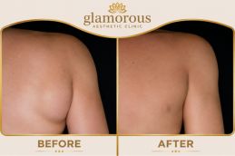 Lipoma treatment before and after Results Dubai 