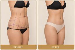 _Lower Body lift Surgery Before and After