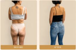_Lower Body lift Surgery Before and After Dubai
