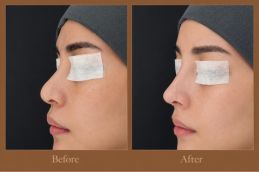 Silicon Nose surgery befor and after in Dubai & Abu Dhabi