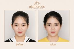Silicon Nose surgery befor and after in Dubai