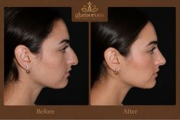 Silicon Nose surgery befor and after