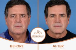 male Brow lift Surgery Before and After result at glam clinic